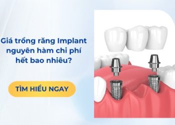 Giá trồng răng Implant nguyên hàm chi phí hết bao nhiêu?