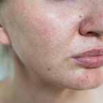lamsaoChăm Sóc Da Nhạy Cảm Đúng Cách