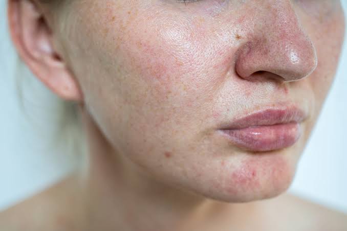 lamsaoChăm Sóc Da Nhạy Cảm Đúng Cách