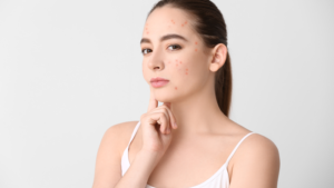 Chăm Sóc Da Hỗn Hợp Đúng Cách