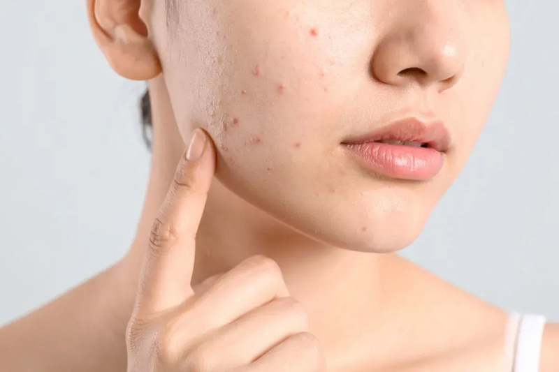 Chăm Sóc Da Khi Bị Mụn